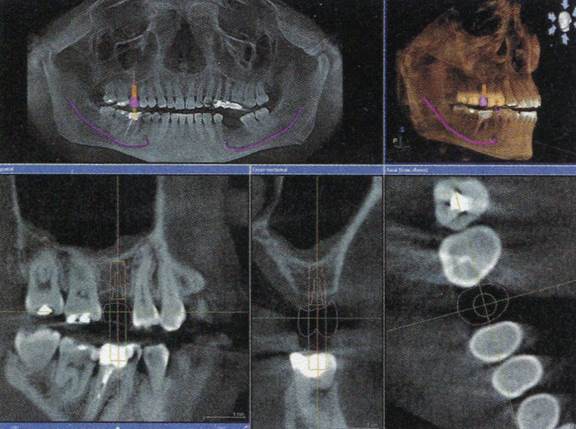 X-Rays of teeth